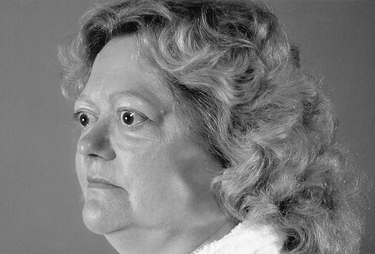 من أسباب فرط نشاط الغدة الدرقية مرض غريفز الذي يصيب يؤثر على العينين