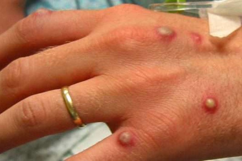 أول إصابة بفيروس