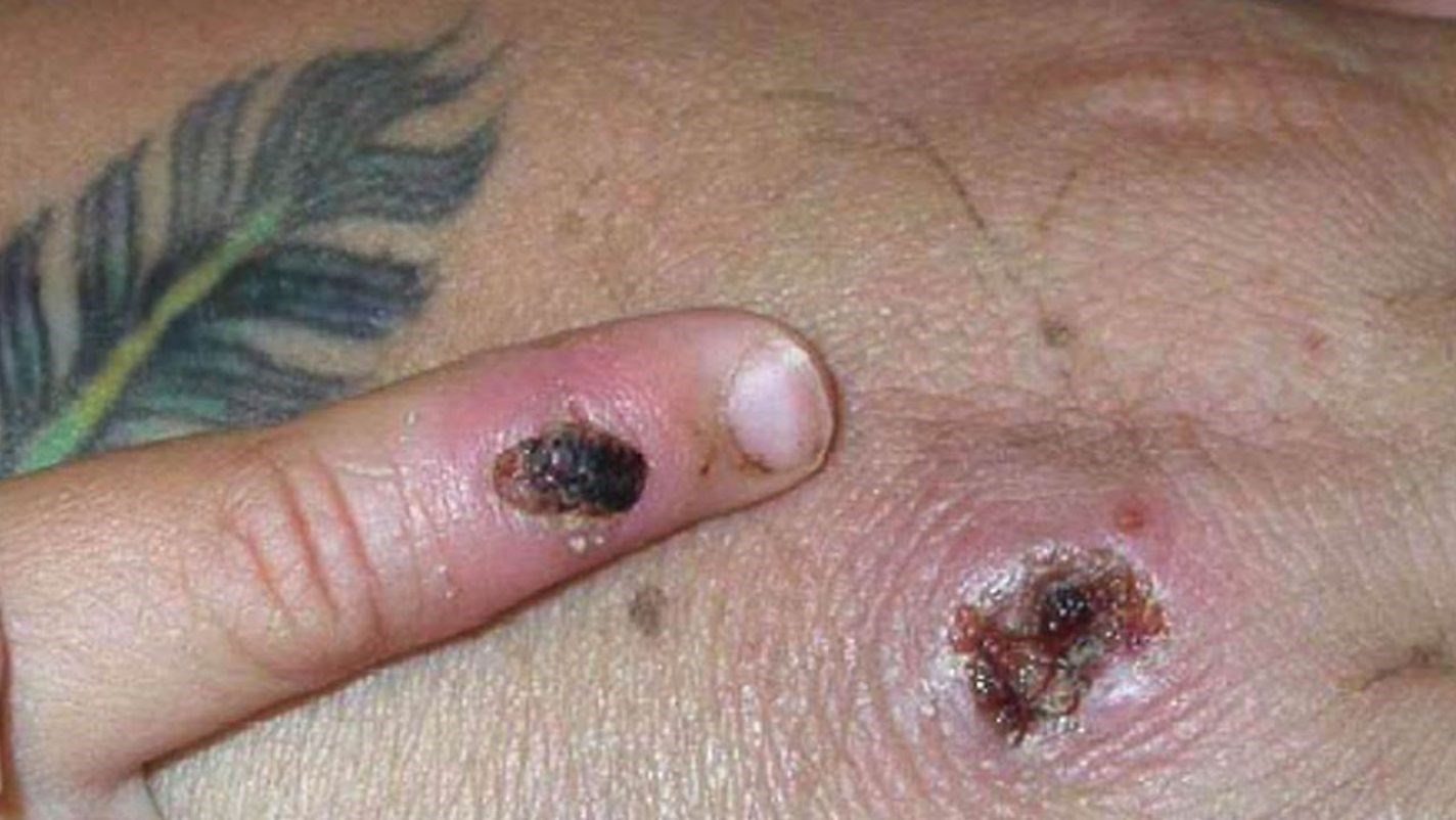 تسجيل أوّل حالتي إصابة بمرض جدري القردة في كندا