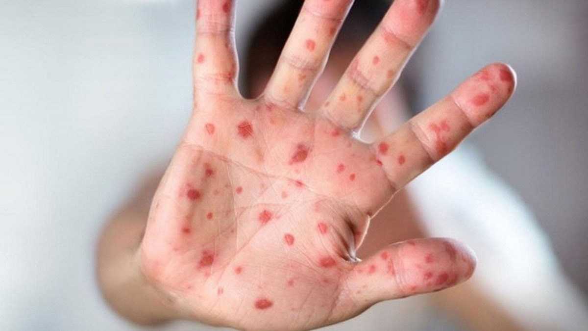 المسؤولة الطبية في منظمة الصحة: فيروس جدري القرود المنتشر حالياً هو نوع بسيط ولا وفيات حتى الآن والمضاعفات قليلة