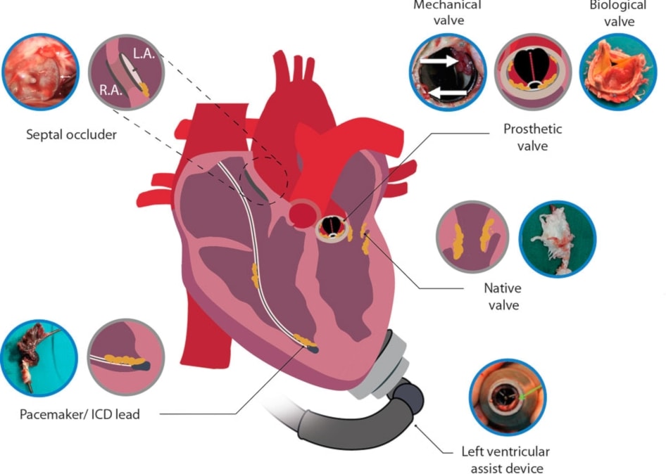الصمام الطبيعي والصمّام الاصطناعي والتهاب الشغاف المعدي المرتبط بجهاز القلب