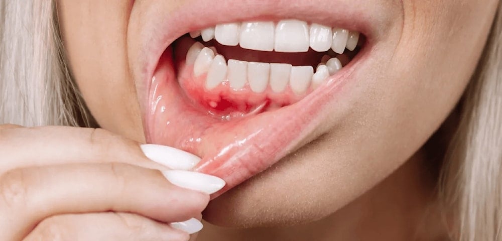 خراج الأسنان..ما هي أسباب هذه الحالة وأعراضها؟