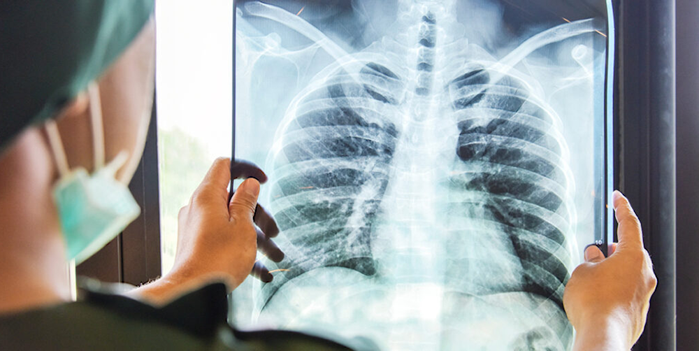  انخفاض وفيات السل بنسبة 3% مقارنةً بعام 2023 وتراجع الإصابات بنسبة 2% مع تسجيل 10.7 مليون حالة في 2024