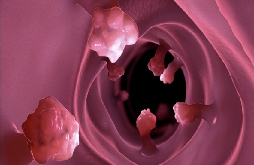 الأطعمة فائقة المعالجة تعزز نمو الزوائد المعوية الممهّدة لسرطان القولون