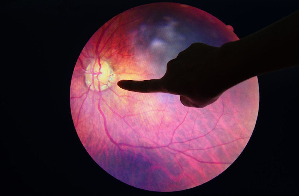 مرض التنكس البقعي المرتبط بالعمر