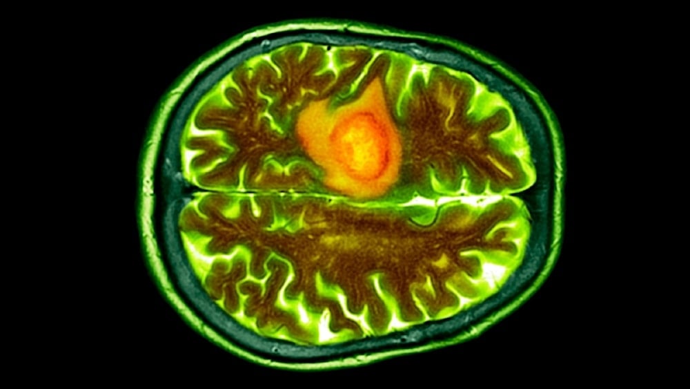 تصوير مقطعي محوسب ملون لورم أرومي دبقي في دماغ مريض. (د. ب. مارازي الصور العلمية جيتي)