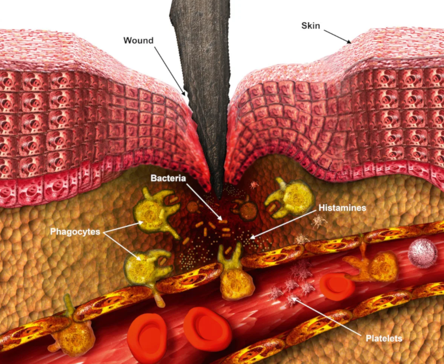 دراسة: جين الشعر الأحمر يكشغ سبب عدم شفاء بعض الجروح المزمنة