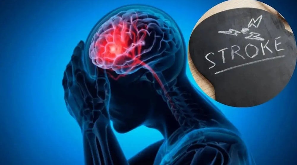 تحدث السكتة عندما تنسدّ أو تضيق شرايين الدماغ ما يؤدي إلى نقص التغذية بالأكسجين وموت الشرايين