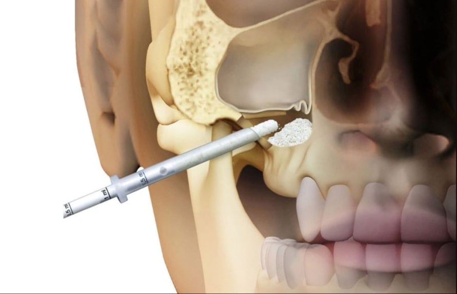 إيران تبتكر تقنية ثلاثية الأبعاد لزراعة عظام قابلة للامتصاص