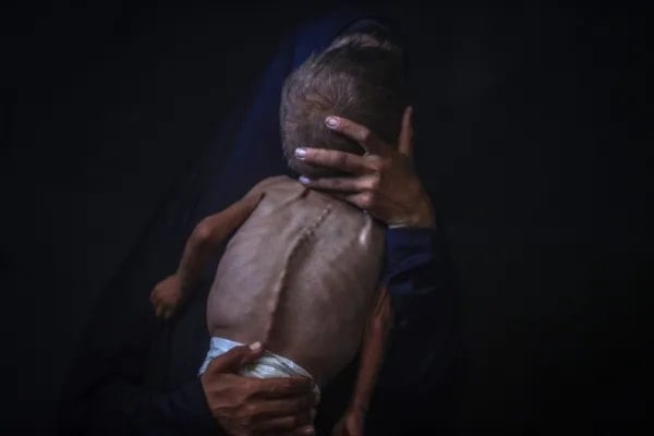 محمد زكريا أيوب المعتوق، البالغ من العمر عاماً ونصف، واحد من آلاف الأطفال الذين يعانون من الجوع وسوء التغذية في غزة 24 تموز/يوليو 2025 (الأناضول) 