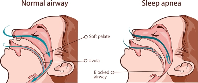 Sleep apnea 